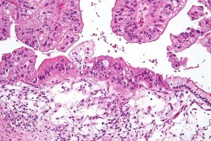 A micrograph of an ovarian tumor (blog.netbio.com).
