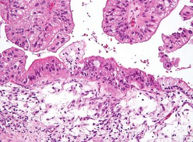 A micrograph of an ovarian tumor (blog.netbio.com).