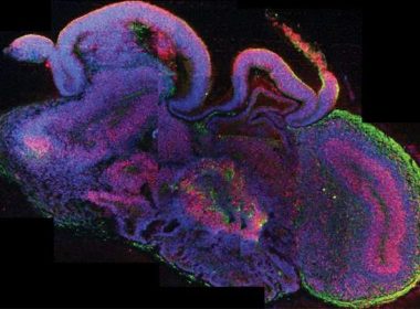 Neural clumps in fetal brains