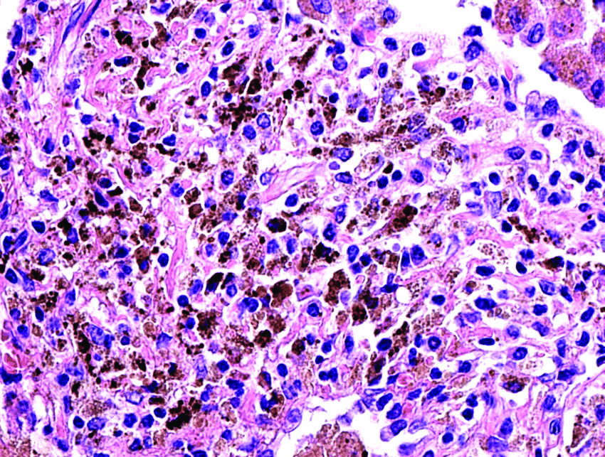 Lung Macrophages Histology Alveolar Macrophages Humpath.com Human