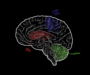 Unraveling the painful mysteries of dyskinetic cerebral palsy